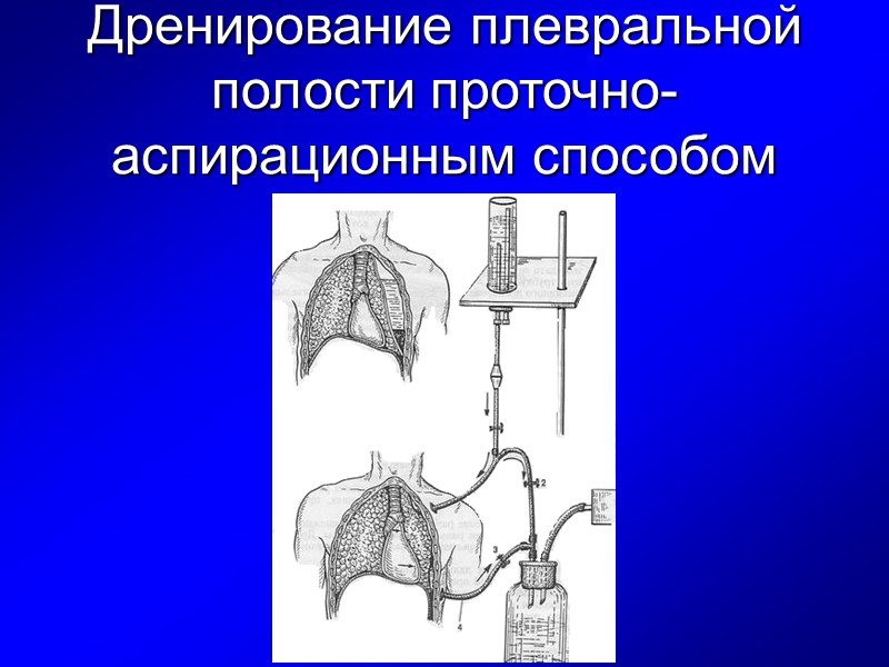 Дренирование плевральной полости проточно-аспирационным способом